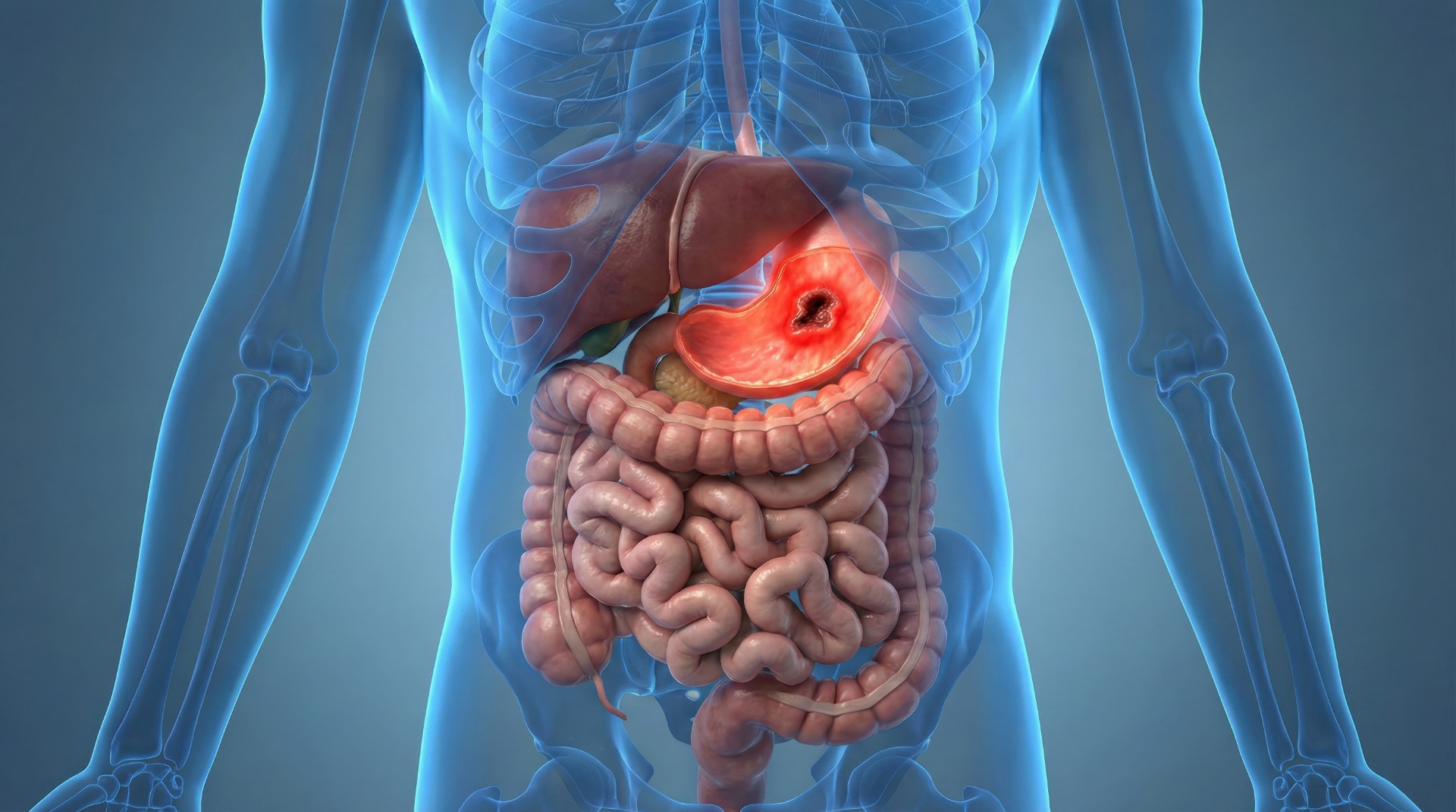 Anatomisk illustration af mavesår i mavesækken