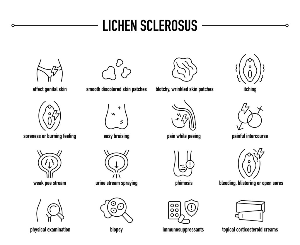lichen sclerosus