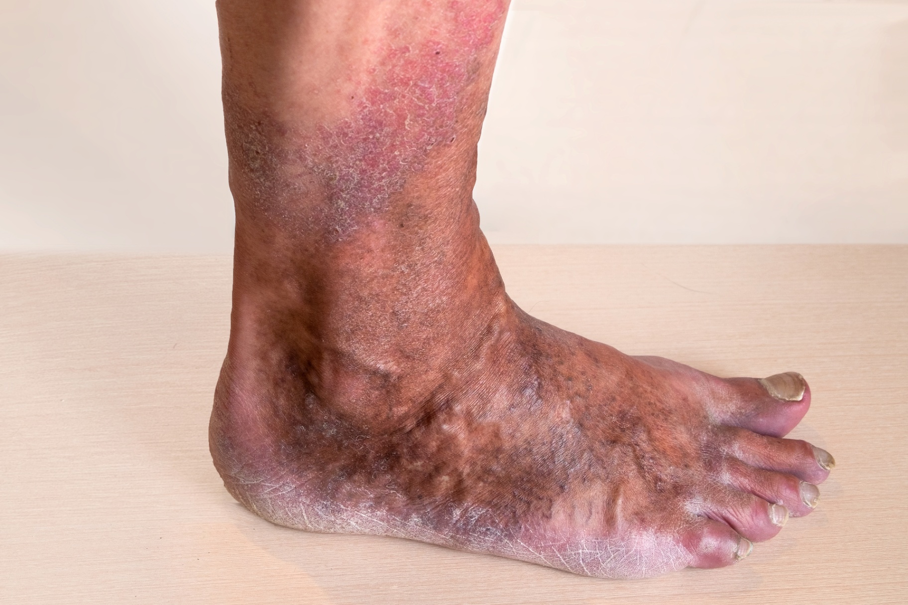 Advanced venous eczema and hyperpigmentation around the ankle in chronic venous insufficiency