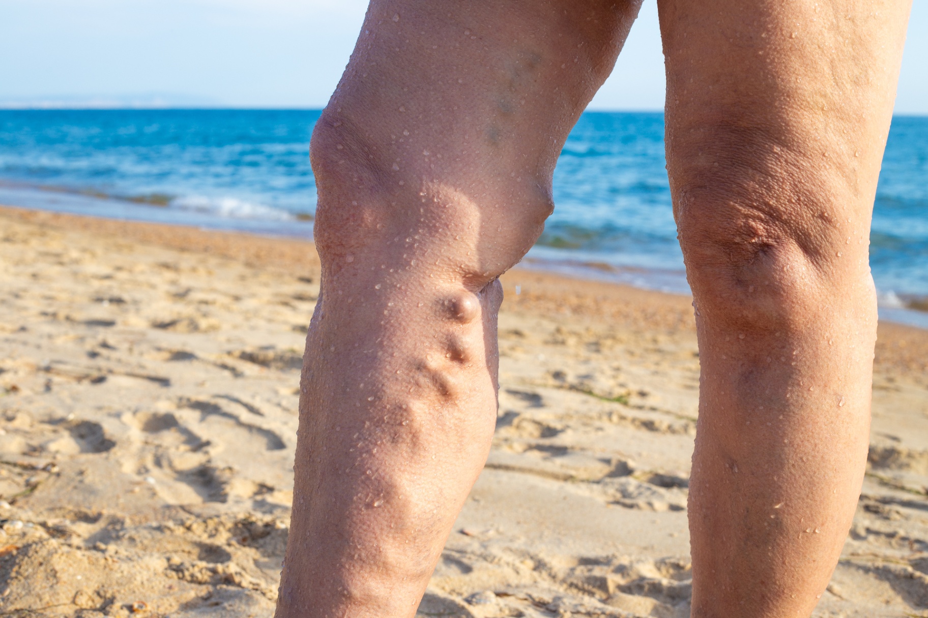 Visible varices (varicose veins) on the lower leg of an active person at the beach