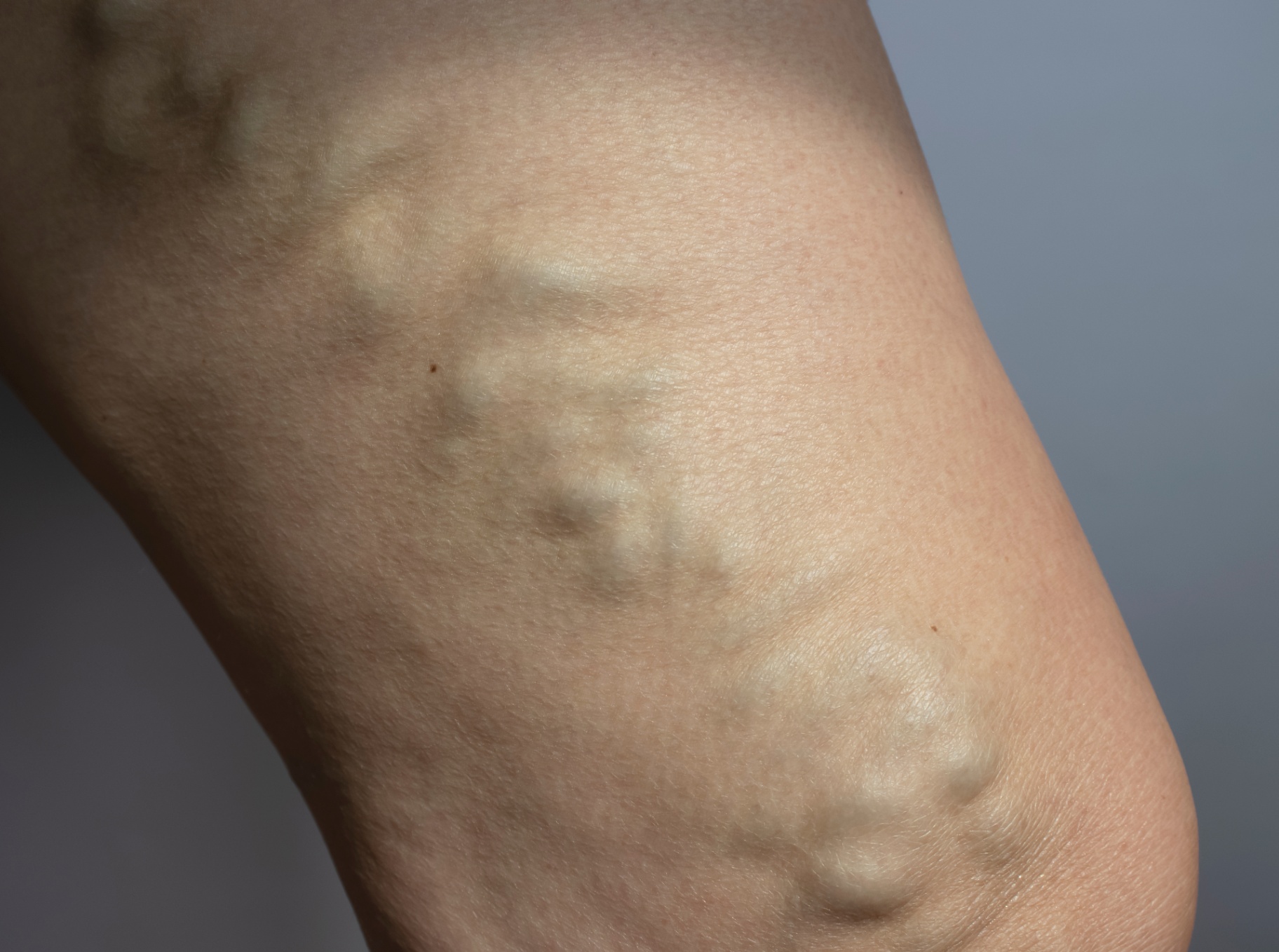 Subtle varicose veins on the lower leg - an early sign of venous insufficiency and heavy, tired legs