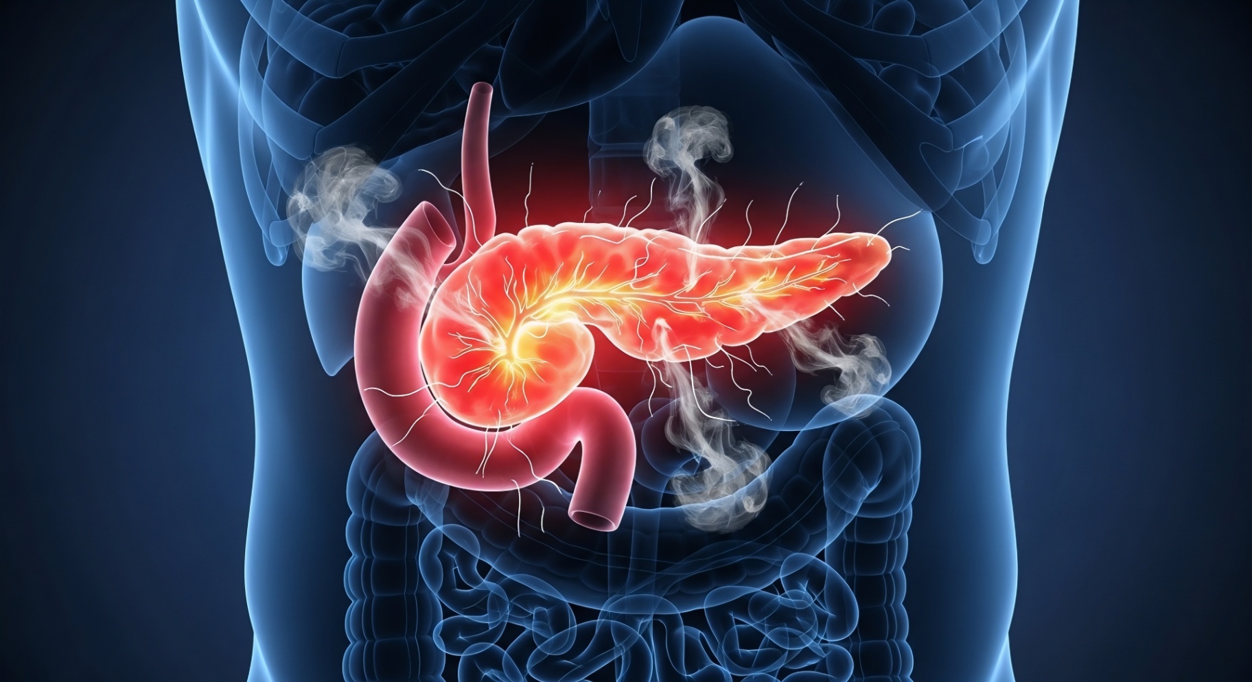 Illustration af inflammeret bugspytkirtel ved pankreatitis