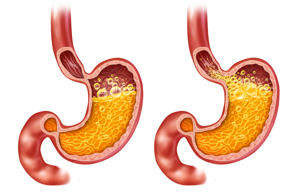 reflux
