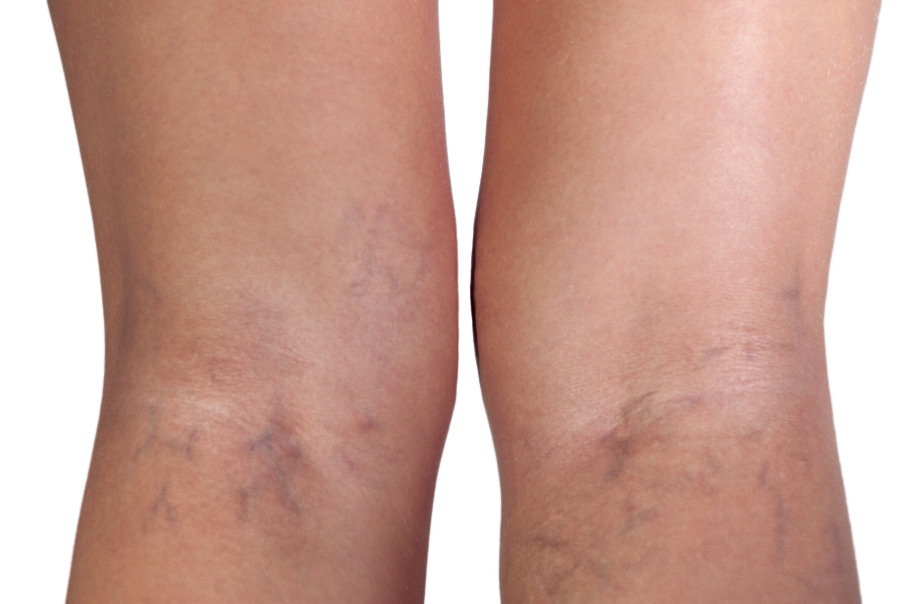Visible superficial veins on the lower leg - a sign that can accompany phlebitis (thrombophlebitis)