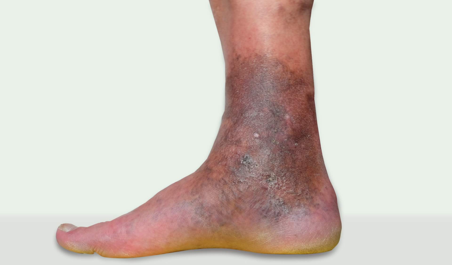 Chronic venous insufficiency with swelling, lipodermatosclerosis and discolouration around the ankle