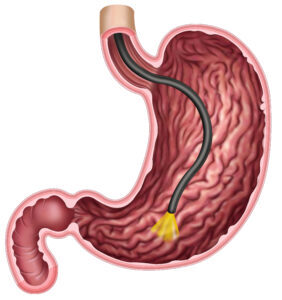 Oral gastroskopi