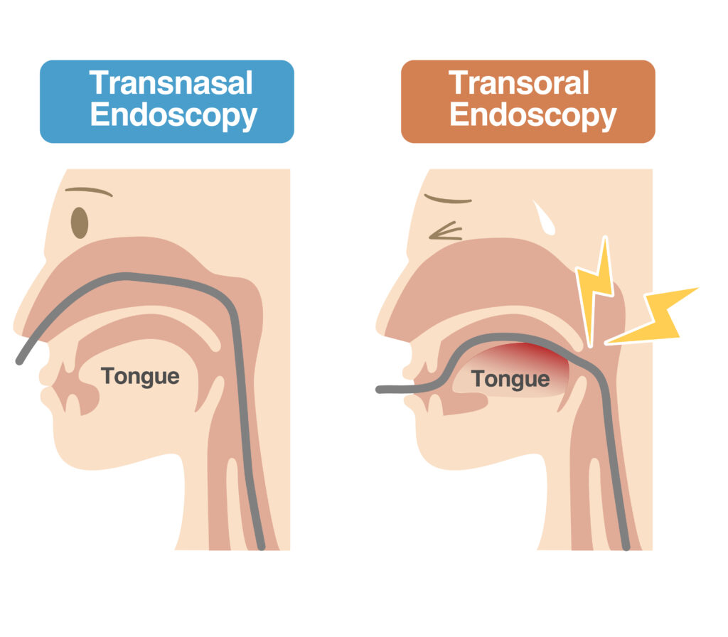 nasal gastroskopi