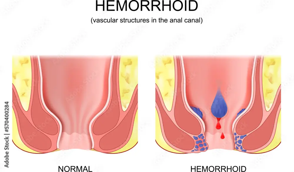 hæmorider