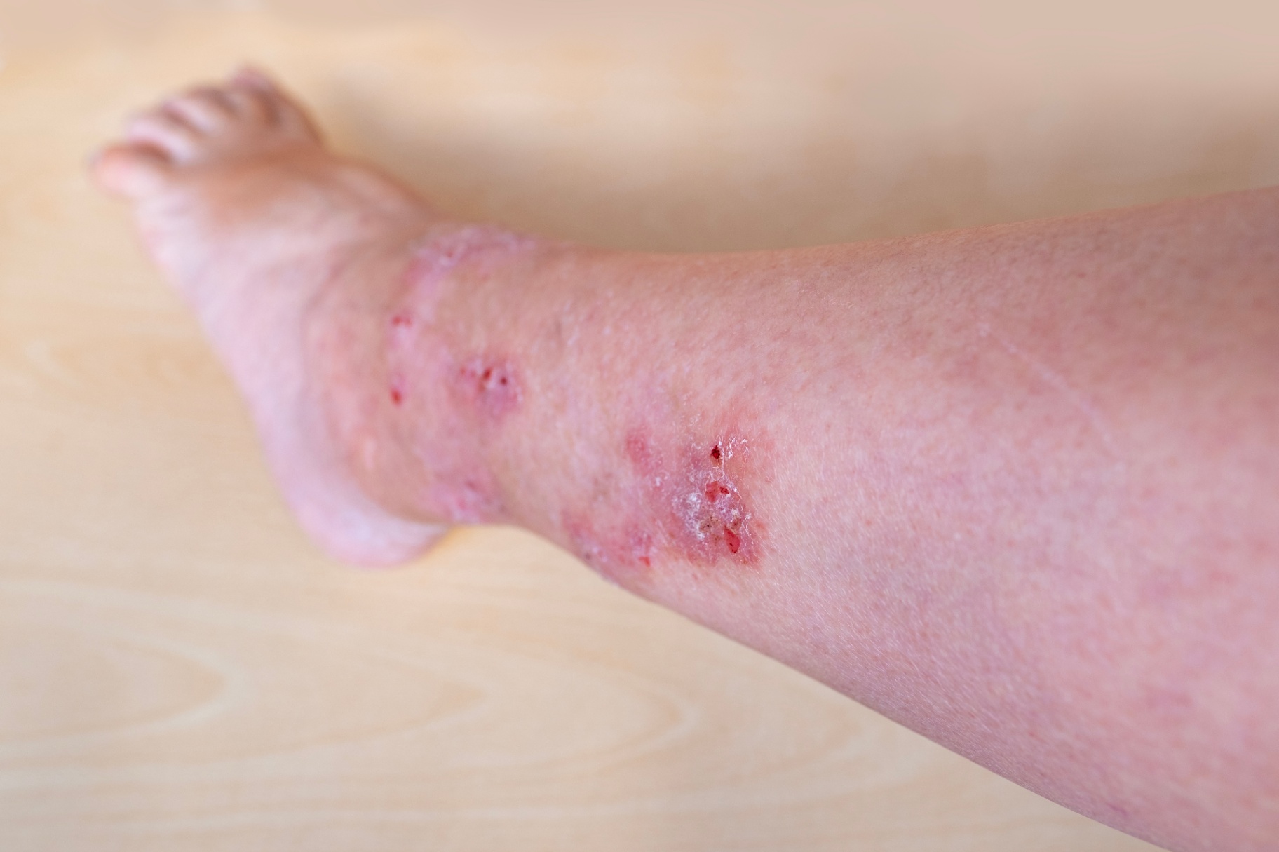 Skin changes and excoriations around the ankle in chronic venous insufficiency