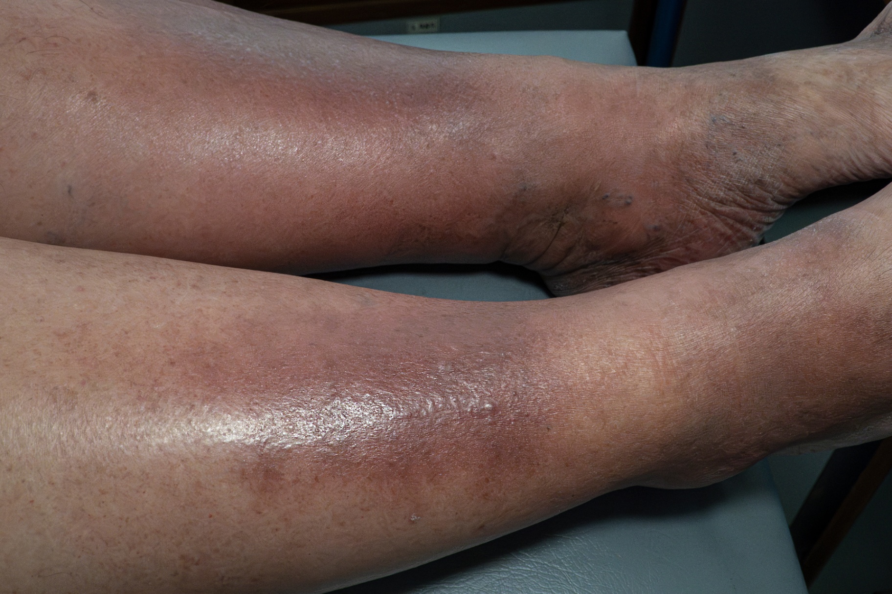 Chronic venous eczema on both lower legs with skin thickening and pigment changes