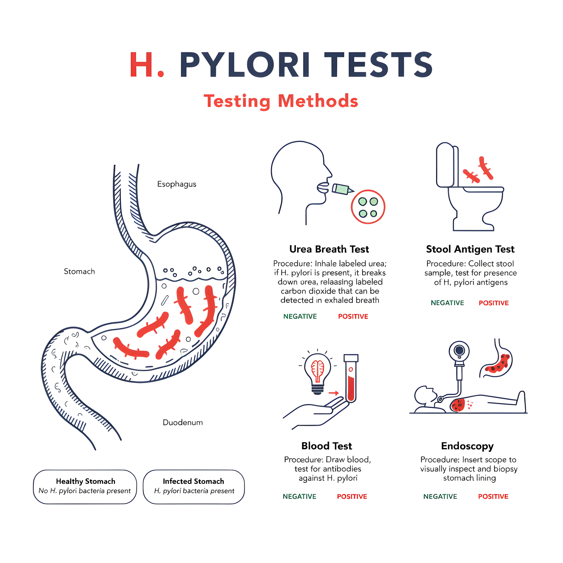 Overview of Helicobacter pylori testing methods: breath test, stool antigen, blood test and endoscopy
