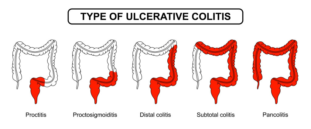 colitis ulcerøsa