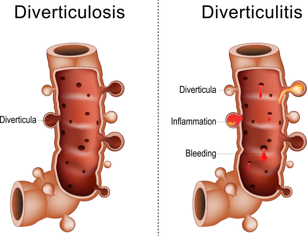 divertikulosis og divertikulitis