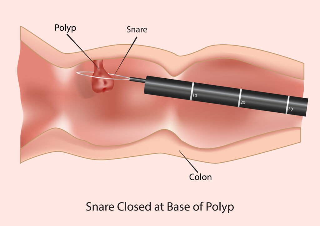 colon polyp