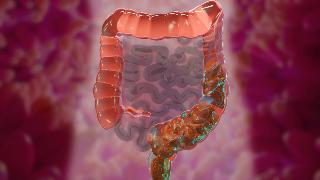 kronisk forstoppelse