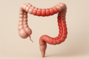 colitis